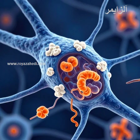 آلزایمر