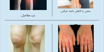 بیماری آرتروز