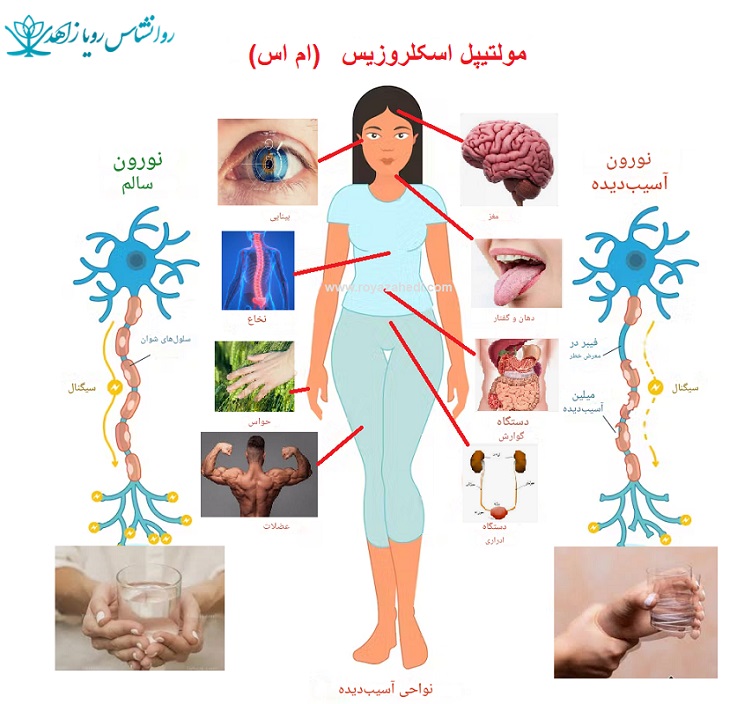 بیماری ام اس