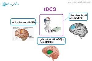 tDCS-در-درمان-درد