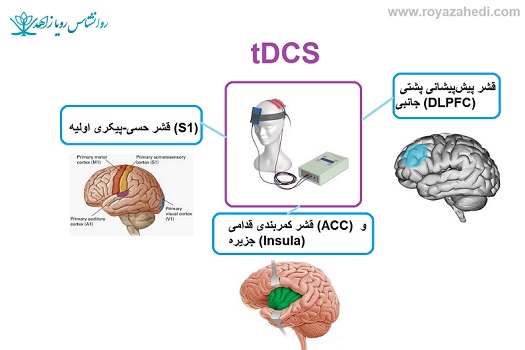 tDCS-در-درمان-درد