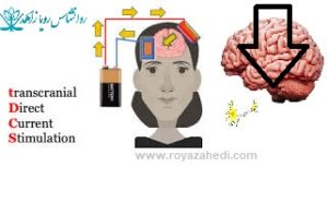 tDCS-و-اضطراب