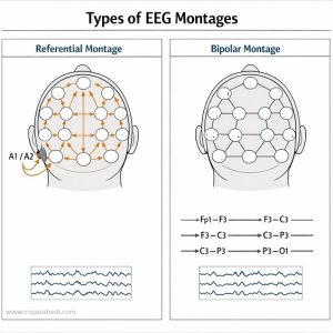 eeg انواع مونتاژ