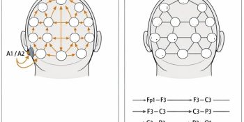 مونتاژهای EEG (Referential vs Bipolar)